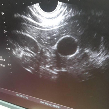 УЗД апарат експертного класу TOSHIBA APLIO XG