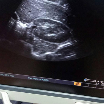 УЗД апарат експертного класу TOSHIBA APLIO XG